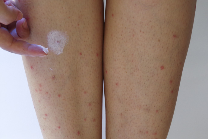 Mujer con manchas rojas en las piernas