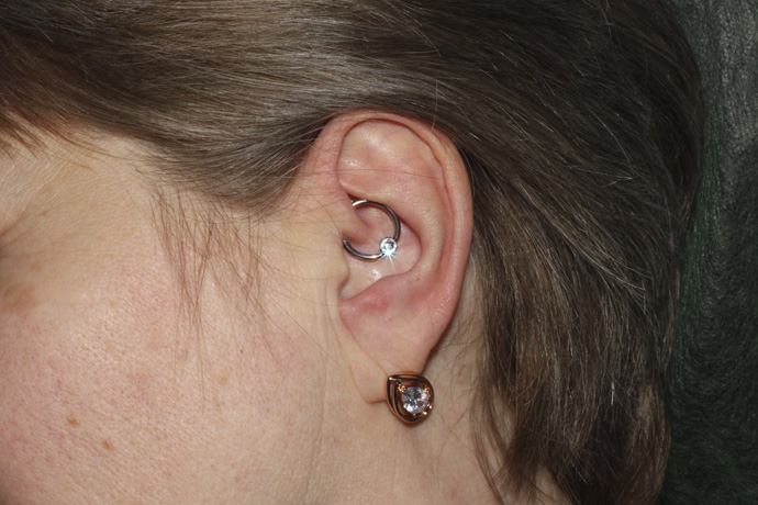 Ubicación anatómica del piercing daith en el cartílago interno de la oreja para el tratamiento de la migraña.